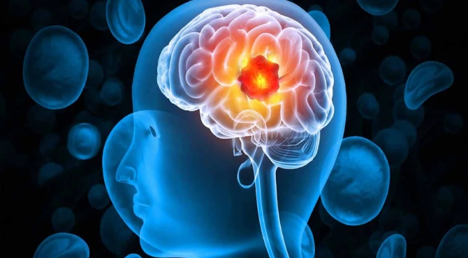 Amoebic-Meningoencephalitis